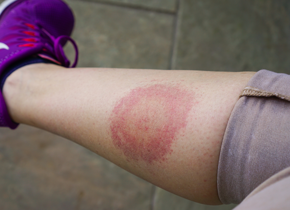 MALATTIA DI LYME: CAUSE E SINTOMI