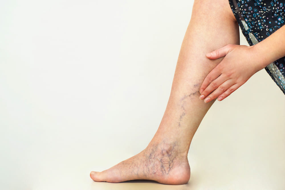 COME PREVENIRE LE VENE VARICOSE? ECCO 7 SEMPLICI CONSIGLI DA SEGUIRE A CASA
