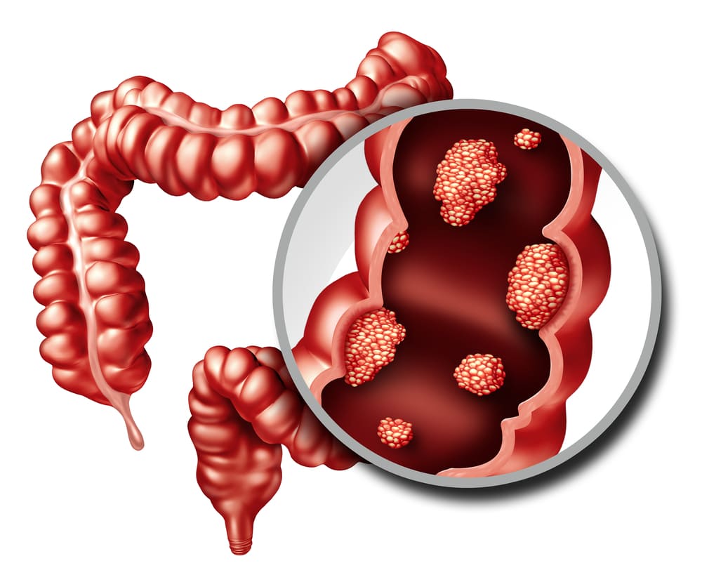 UNA SVOLTA NELLA DIAGNOSI DEL TUMORE DEL COLON-RETTO