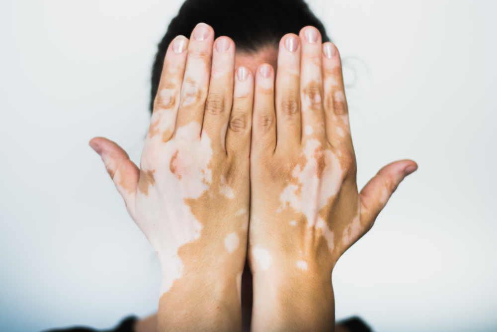 WORLD VITILIGO DAY