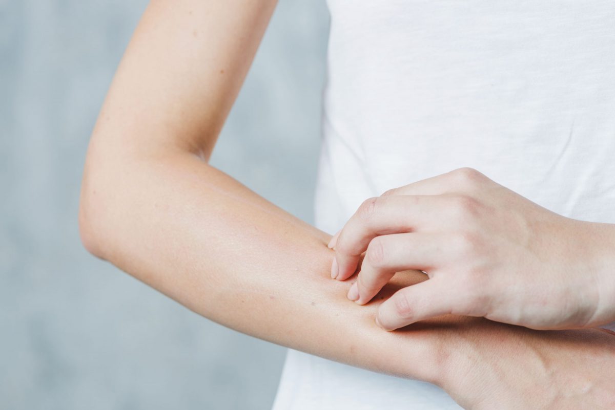 COME CURARE LA DERMATITE ATOPICA IN MANIERA BIOLOGICA