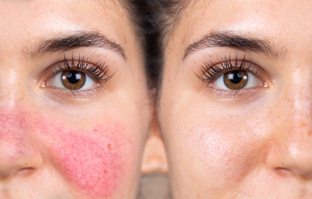 ROSACEA, TUTTO CIÒ CHE BISOGNA SAPERE