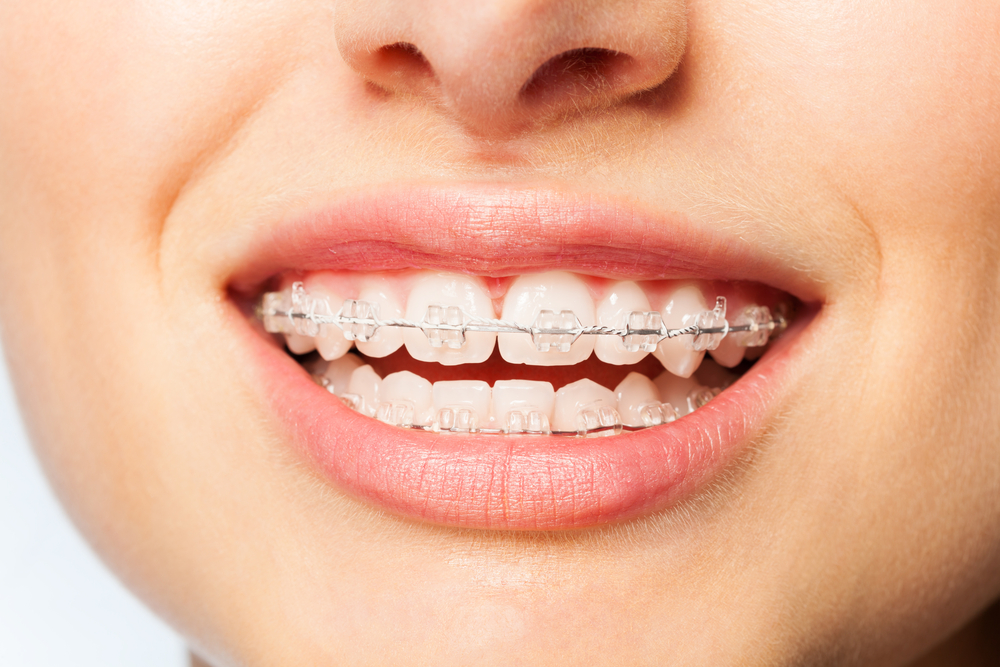 I 4 BENEFICI DELL’APPARECCHIO PER I DENTI