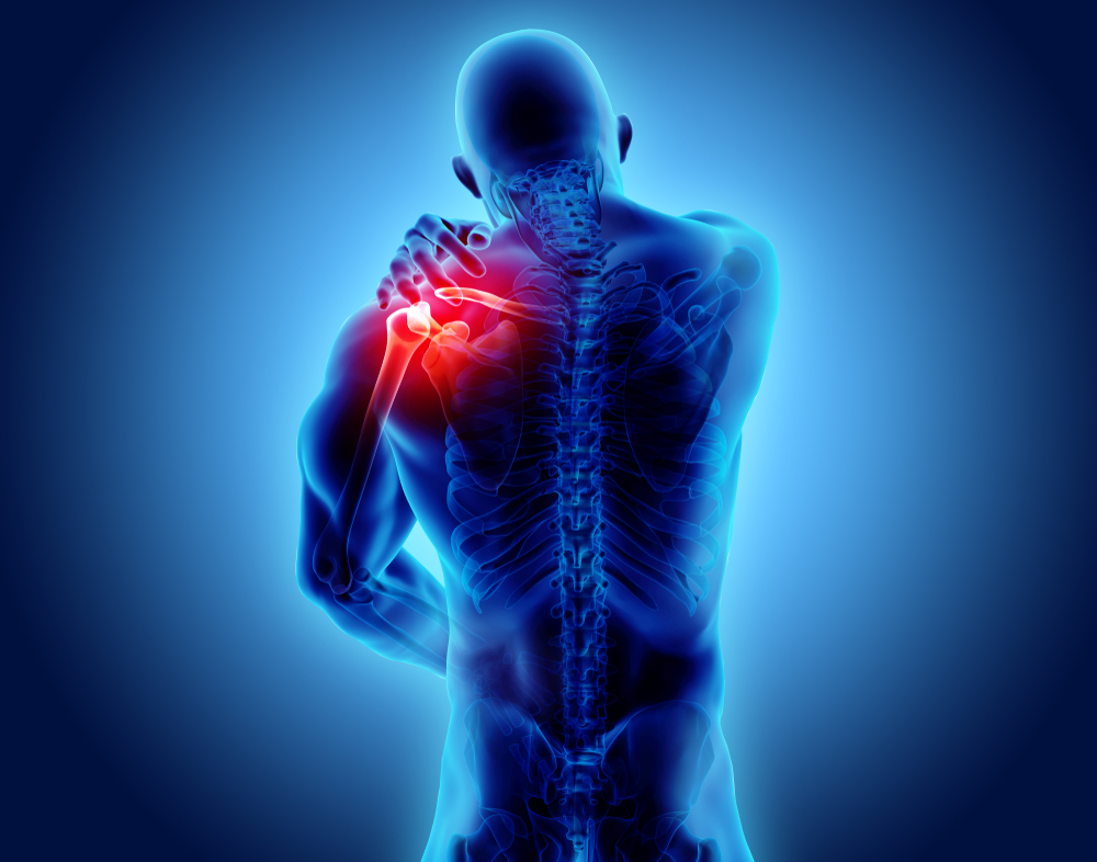 SINDROME DELLA SPALLA CONGELATA: IL SIGNIFICATO