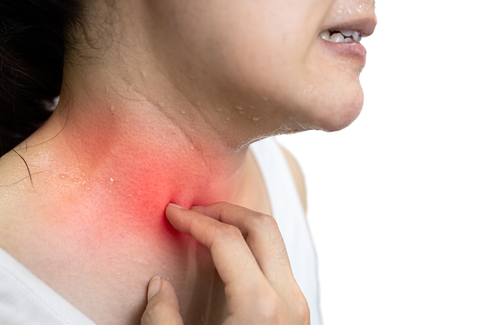 DERMATITE DA SUDORE: COME PREVENIRLA?