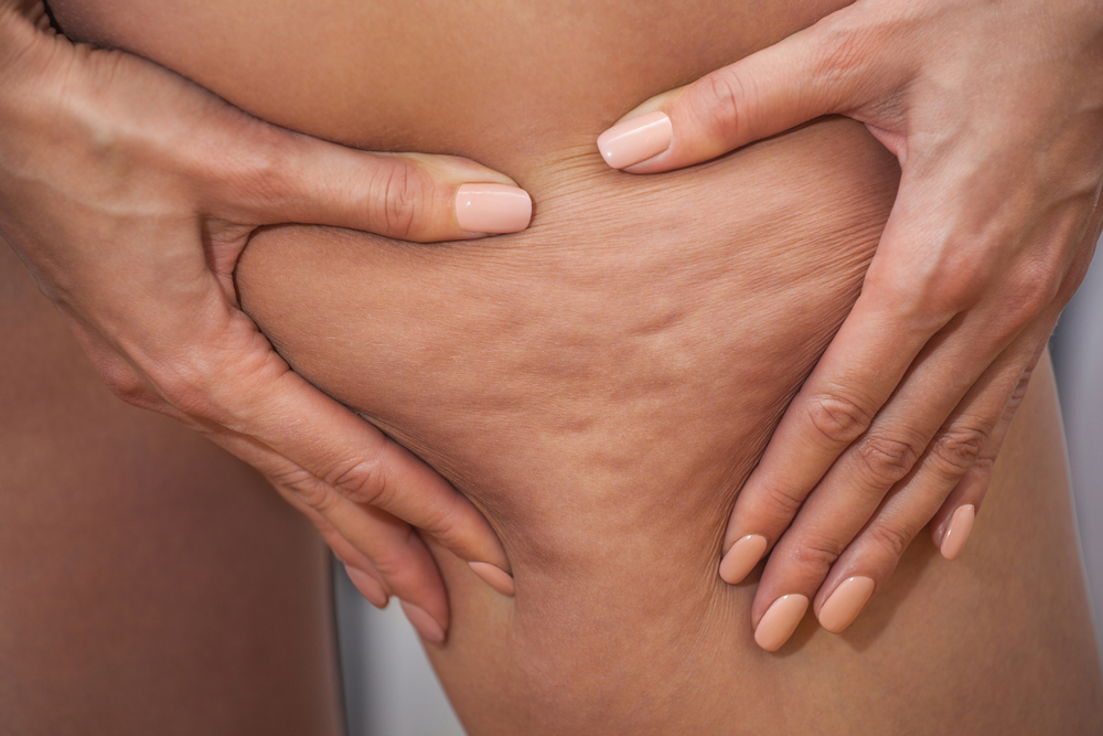 LA CELLULITE PROTEGGE LA NOSTRA SALUTE, ARRIVA LO STUDIO