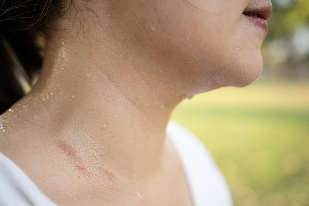 COME PREVENIRE LA DERMATITE DA SUDORE
