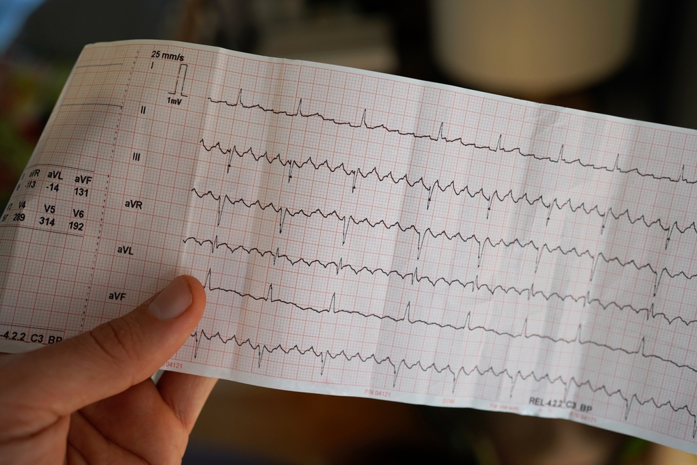 Fibrillazione atriale e il cuore che “saltella”