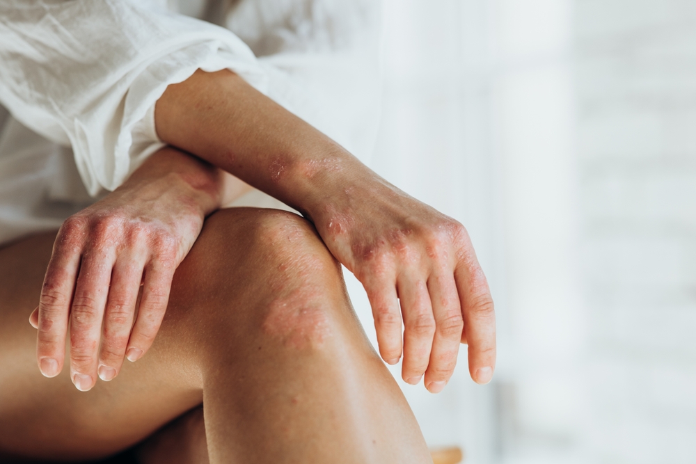 Psoriasi: luoghi comuni e verità