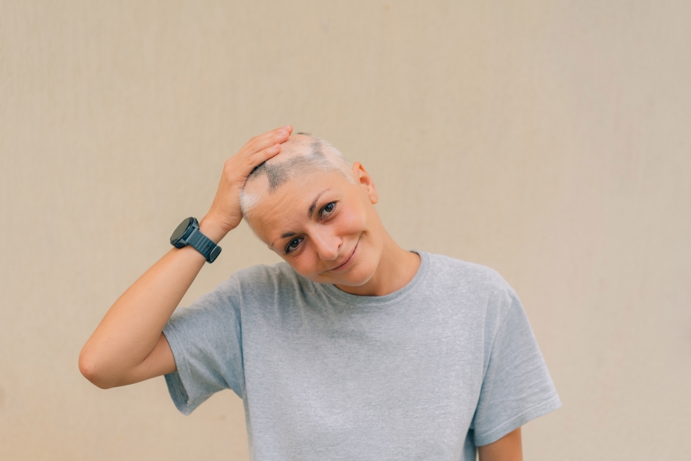 Nuove armi contro l’alopecia areata