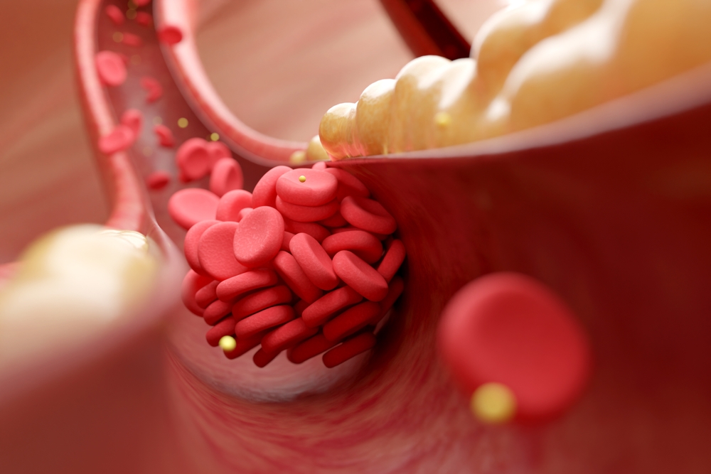 Displipidemia: cos’è e come contrastarla