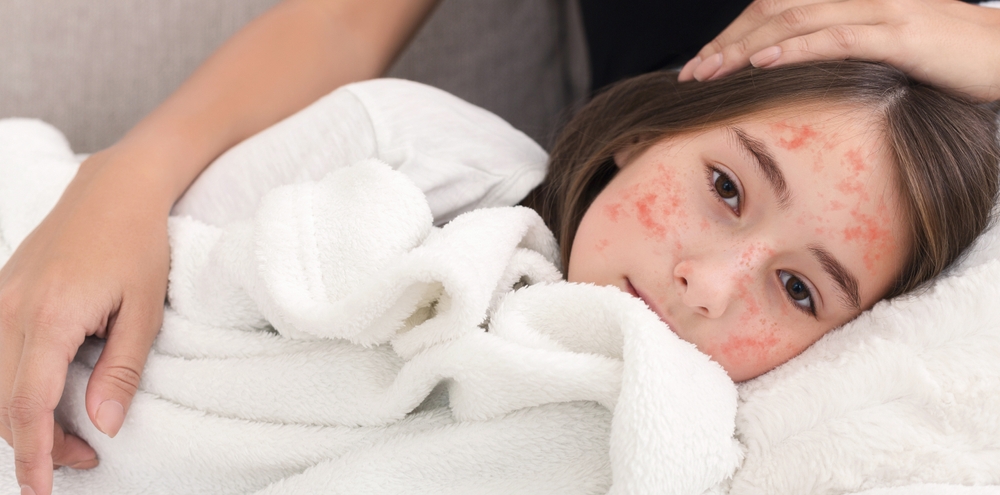 bambino con esantema da morbillo