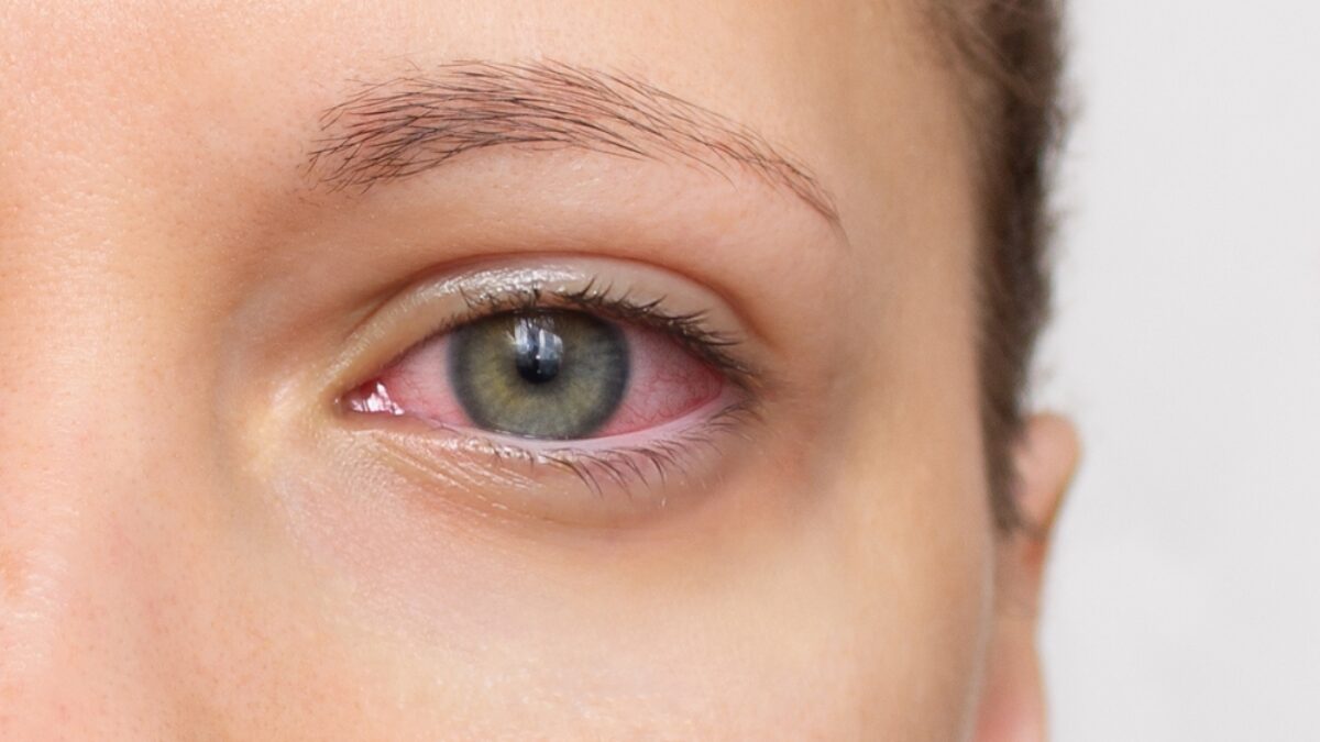 Allergie oculari in primavera con occhi arrossati e lacrimazione