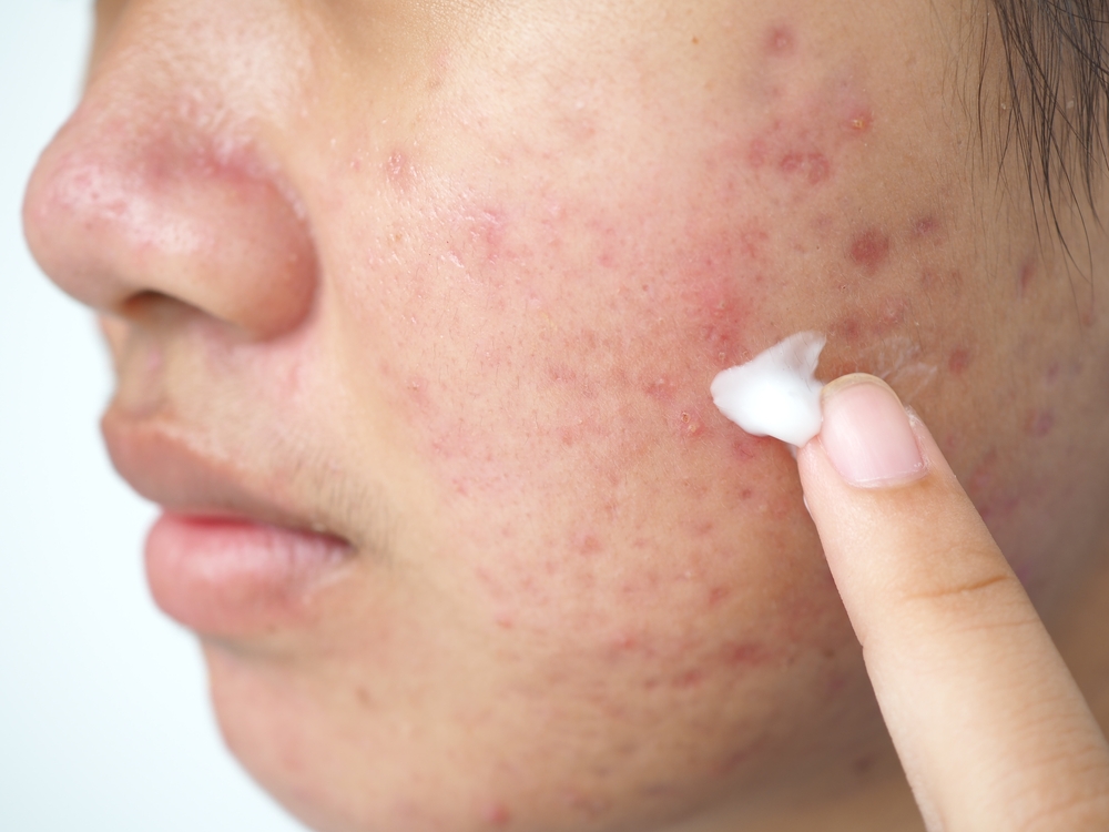 Acne: cos’è, perché compare e come trattarla sul viso adolescente