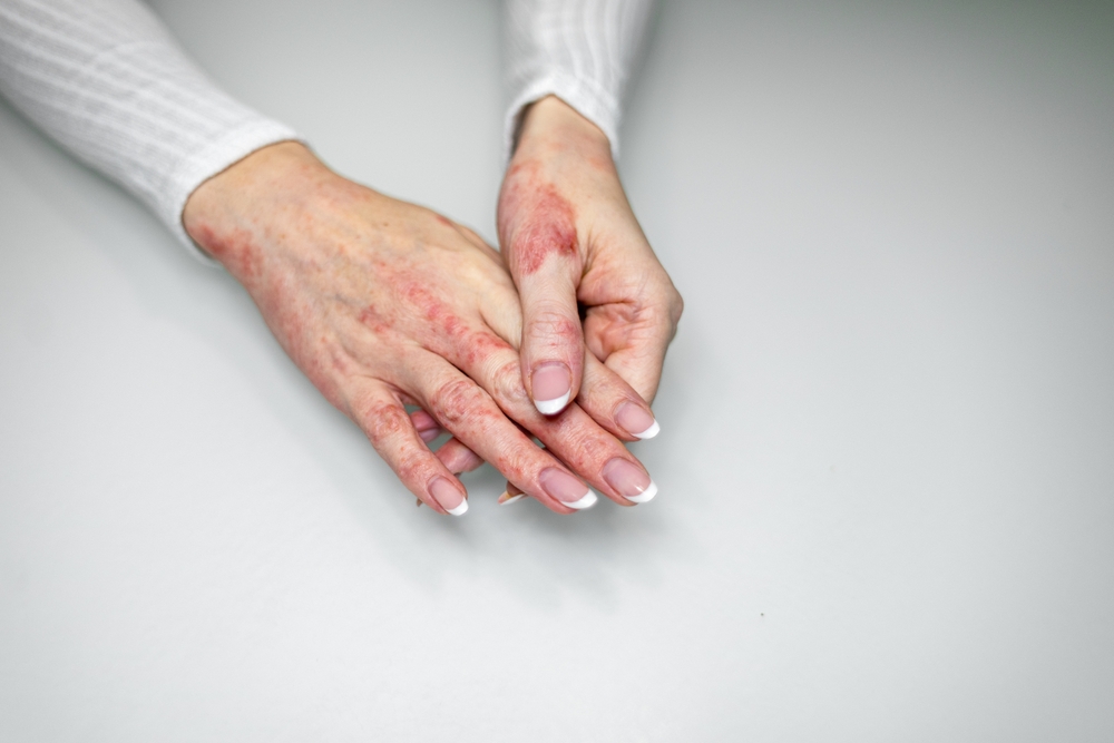 Dermatite da contatto sulla mano valutata dal dermatologo